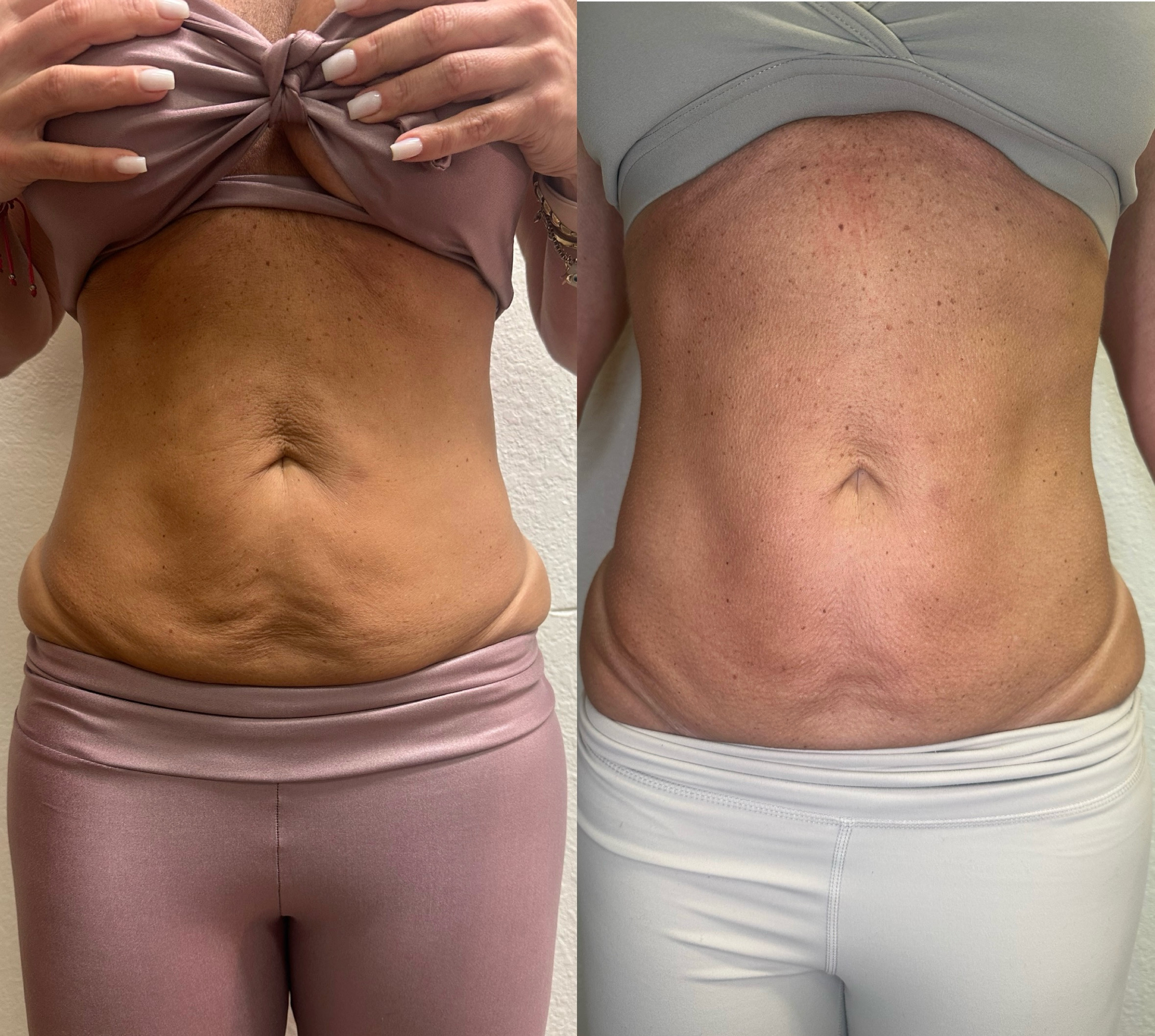 Female body contouring before and after — waist and abdomen, Rejuvenate & Wellness Center