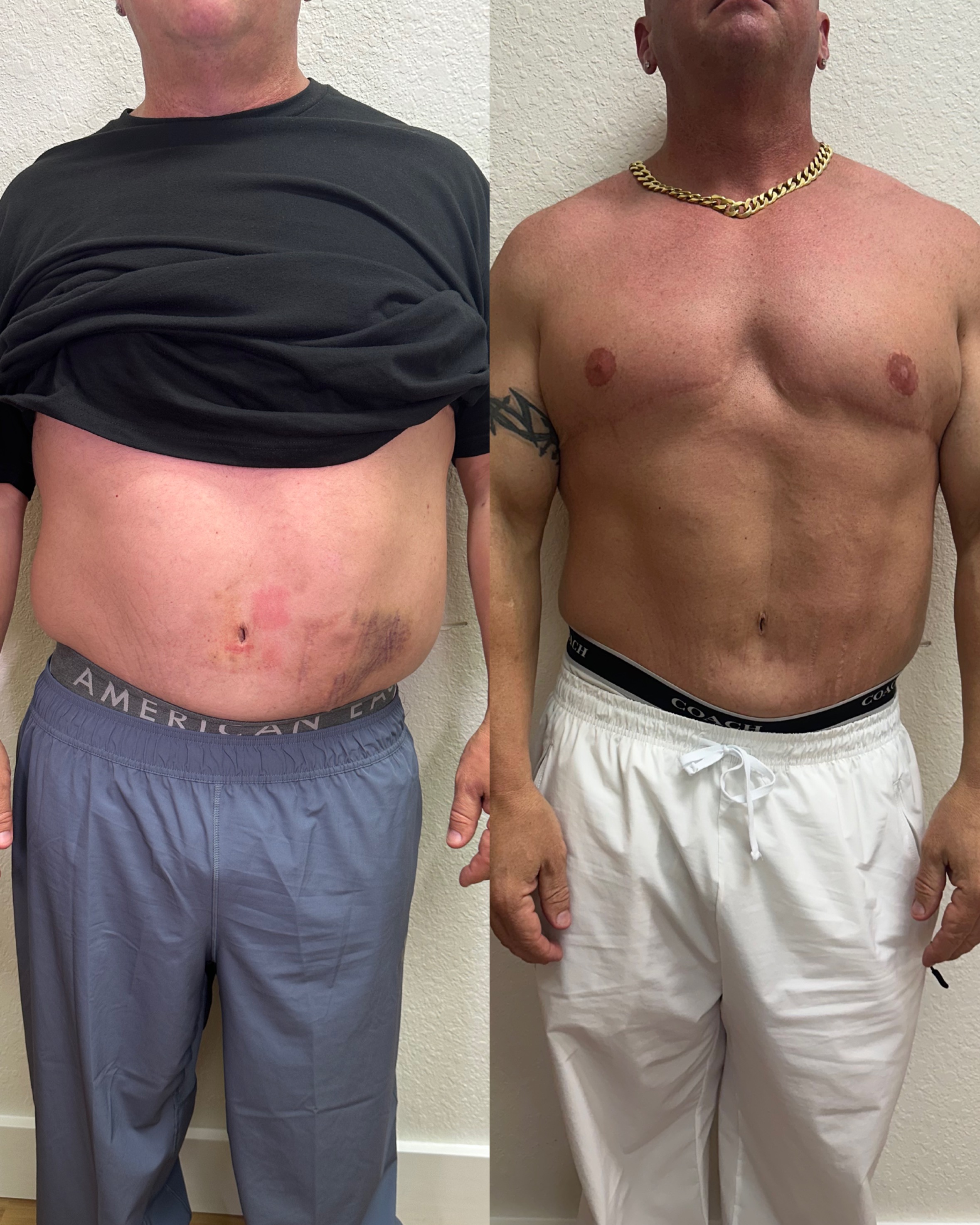 Male body contouring before and after — front view, Rejuvenate & Wellness Center