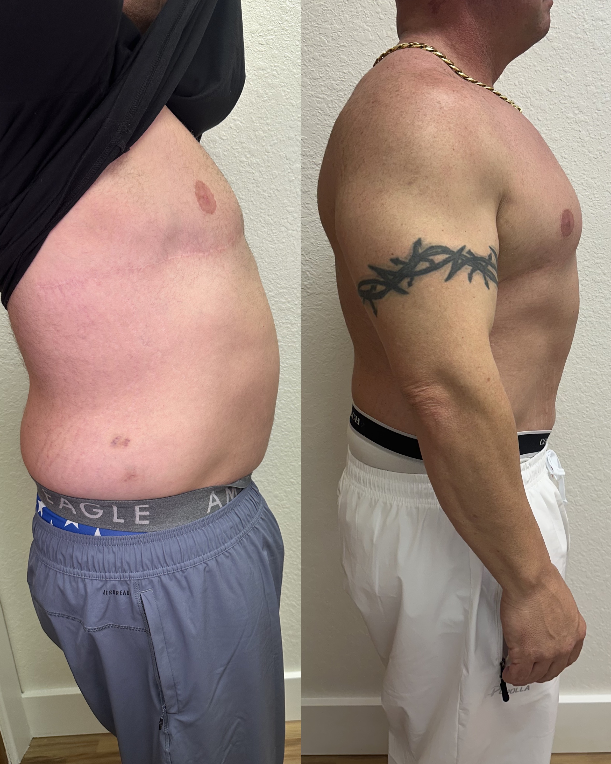 Male body contouring before and after — side profile, Rejuvenate & Wellness Center