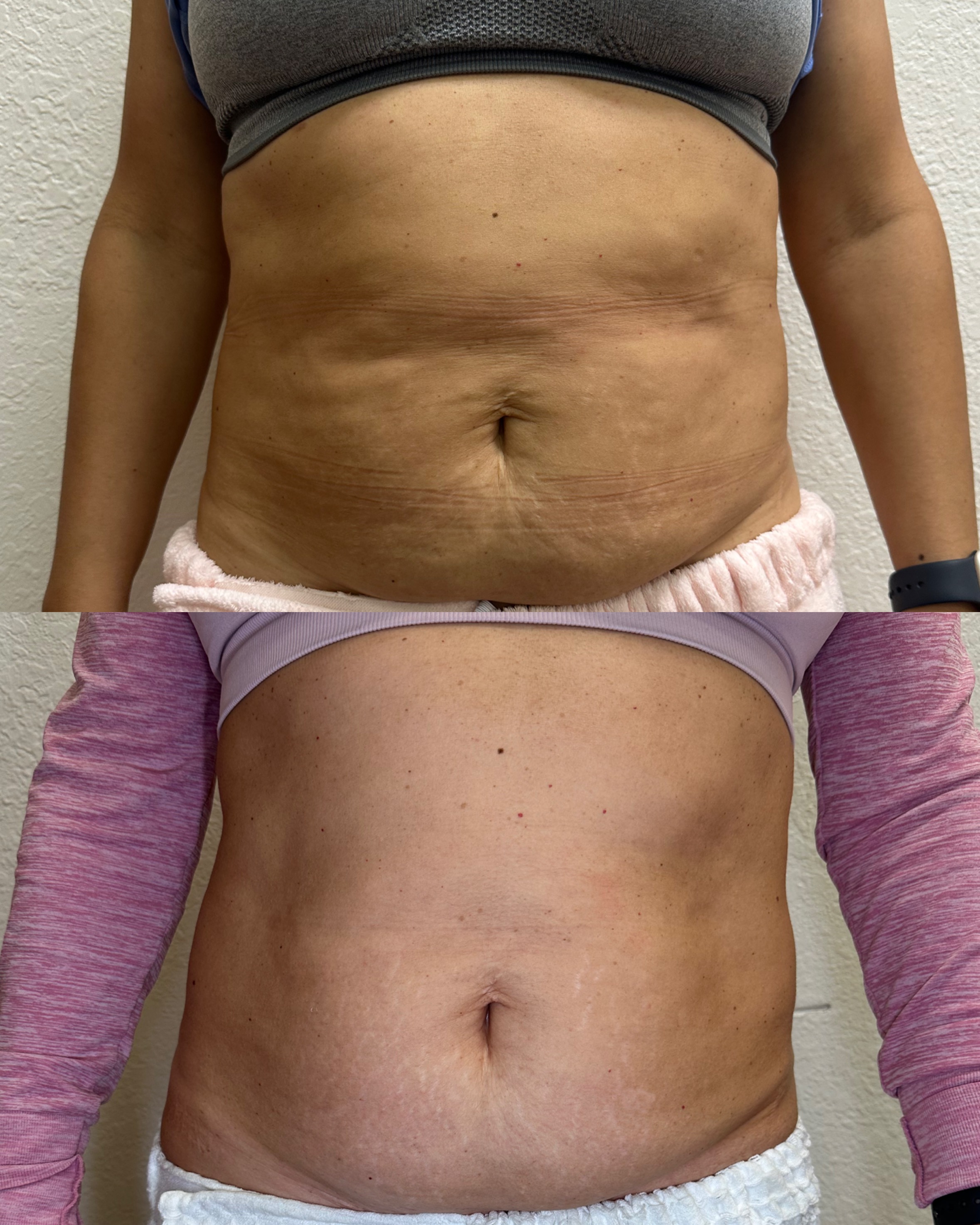 Female body contouring before and after — abdomen, Rejuvenate & Wellness Center